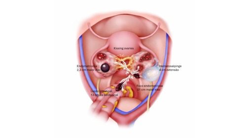 Ilustração anatômica de endometriose profunda